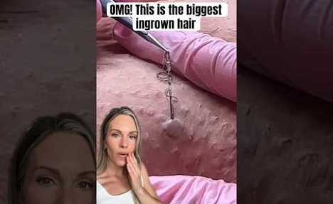 OMG! THIS IS THE WORLDS BIGGEST INGROWN HAIR REMOVAL! #shorts